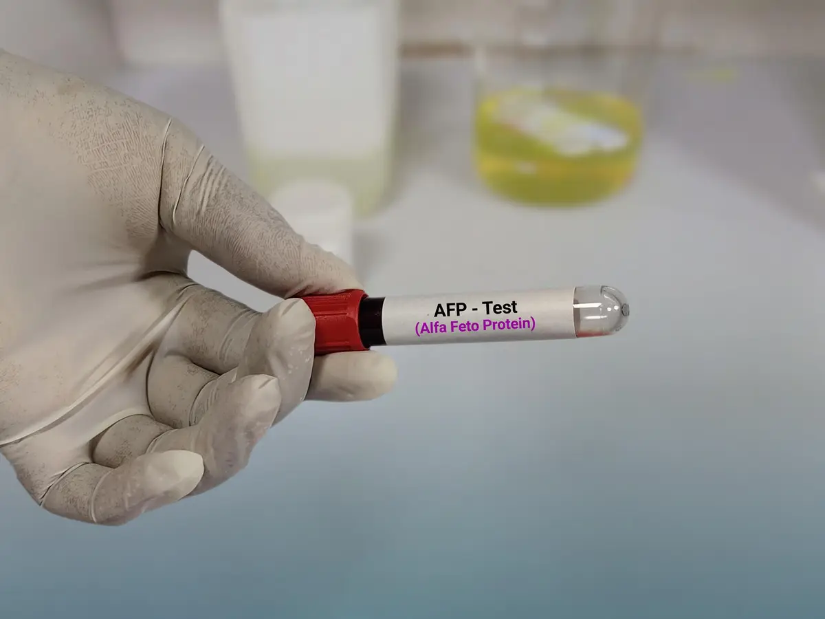blood test liver cancer AFP marker