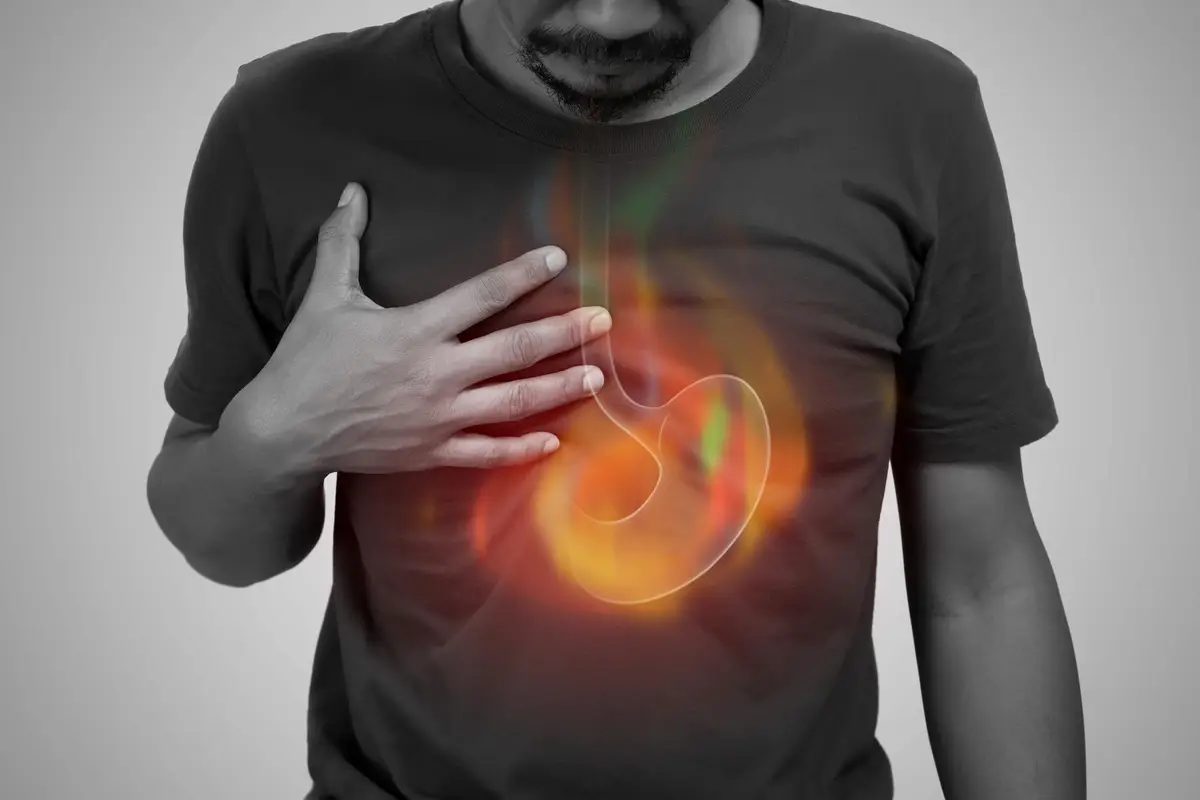 estomac reflux